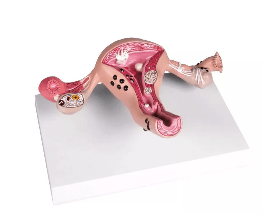 Uterusmodell mit Erkrankungen - Erler - Zimmer