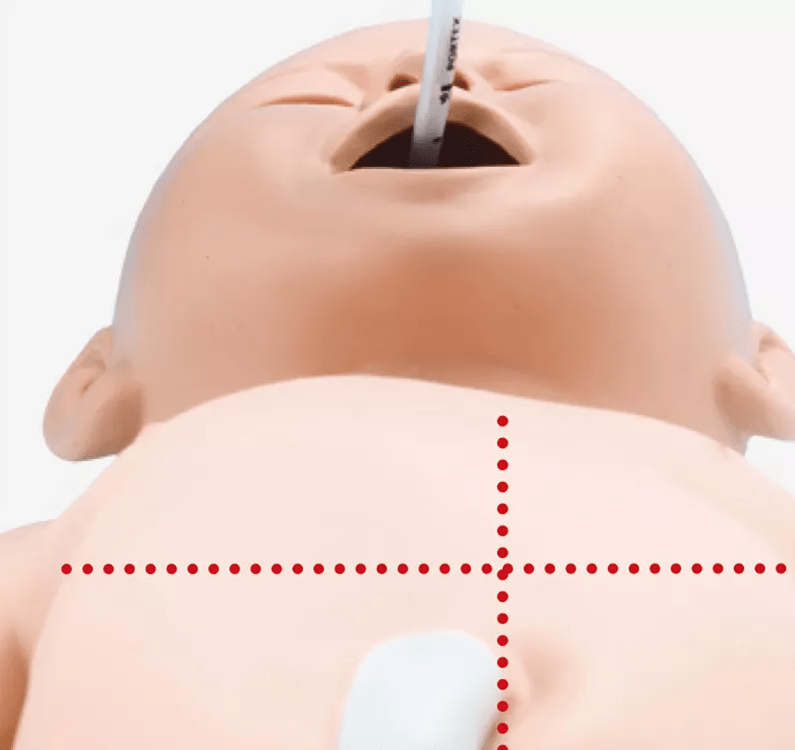 Intubations - und Wiederbelebungs - Neugeborenes - Erler - Zimmer