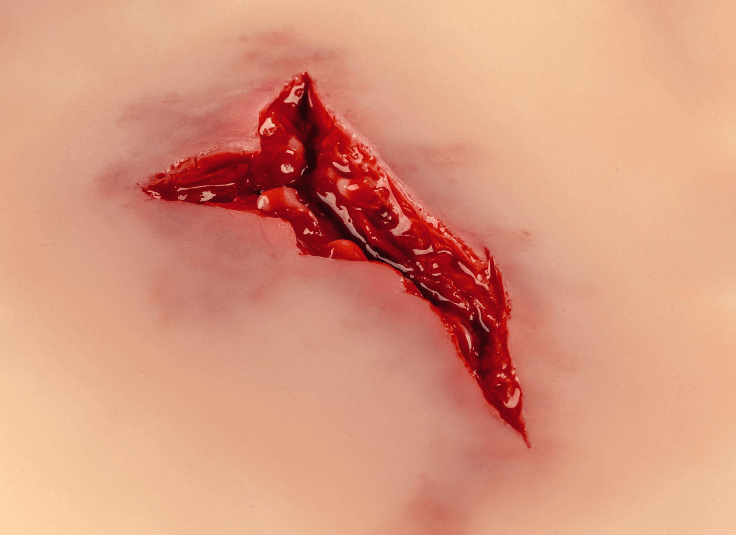 Wundmoulage Risswunde - Erler - Zimmer