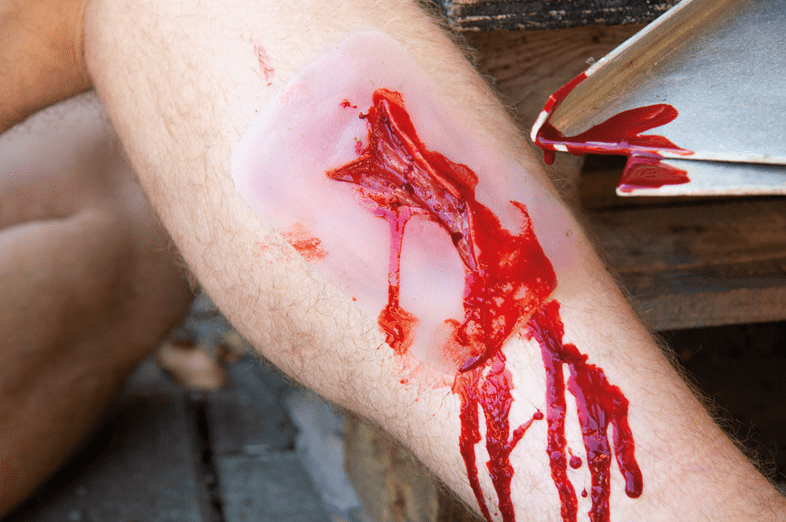 Wundmoulage Risswunde - Erler - Zimmer