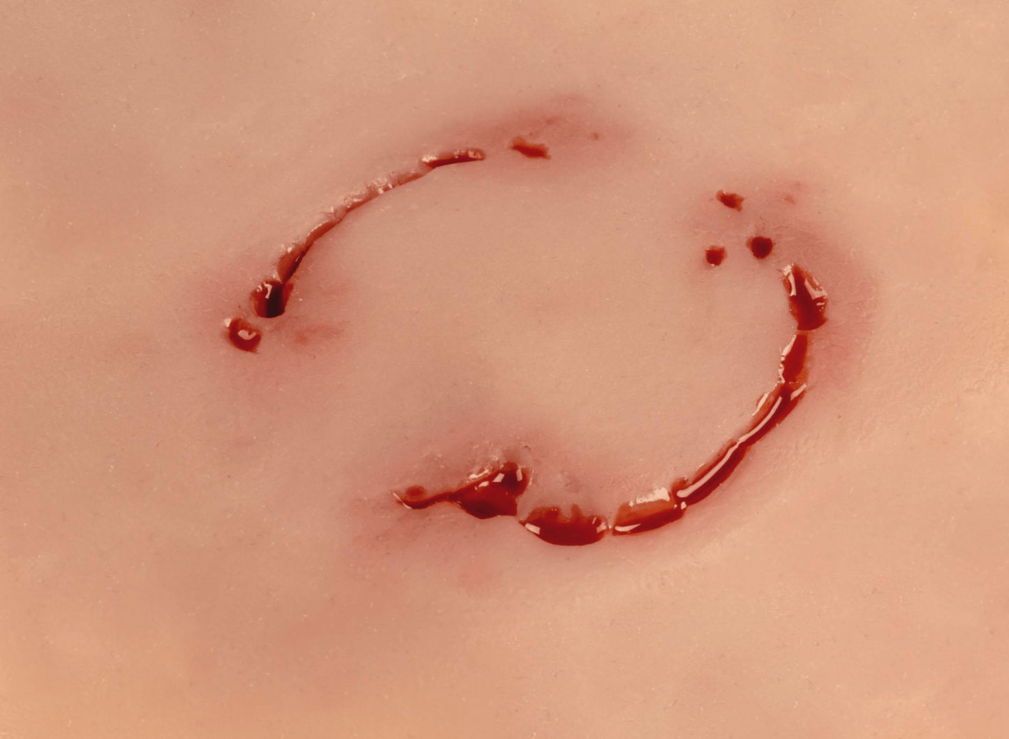 Wundmoulage Bisswunde Mensch - Erler - Zimmer