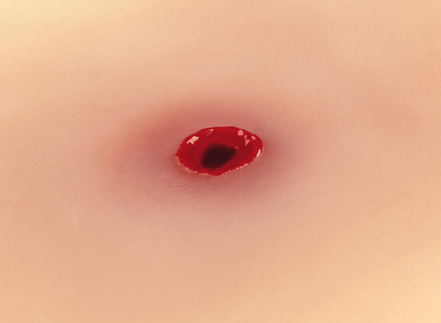 Wundmoulage Einschußwunde - Erler - Zimmer