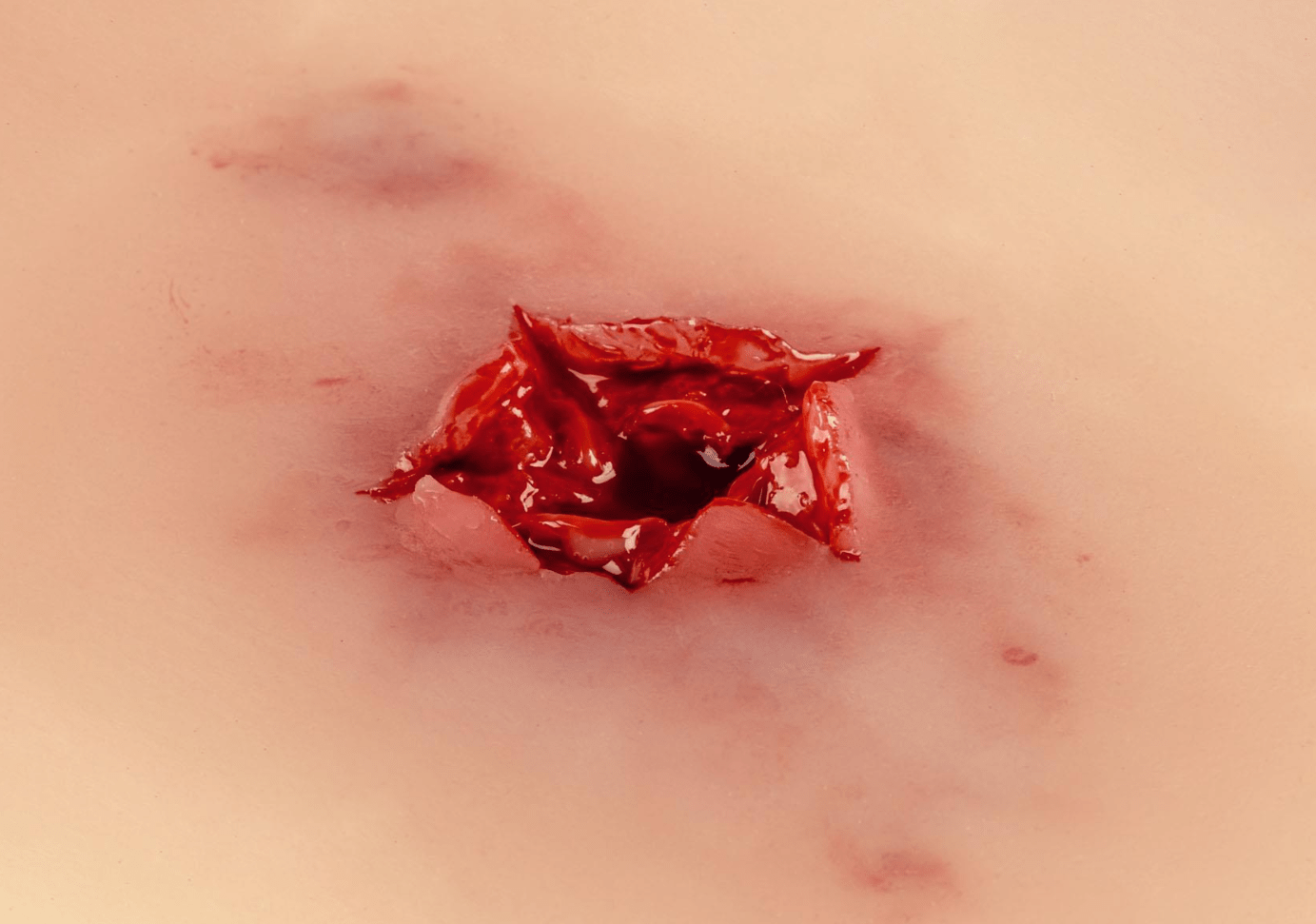 Wundmoulage Schuß Austrittswunde - Erler - Zimmer