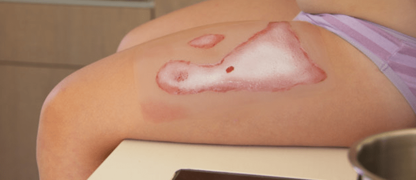 Wundmoulage Verbrühung - Erler - Zimmer