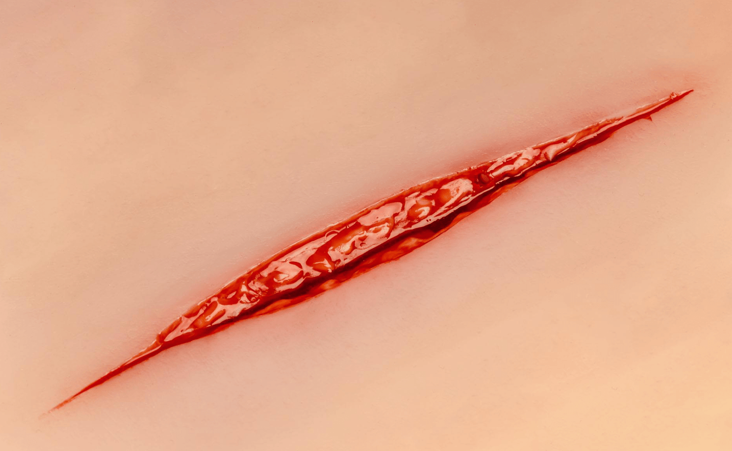Wundmoulage Suizidversuch - Erler - Zimmer