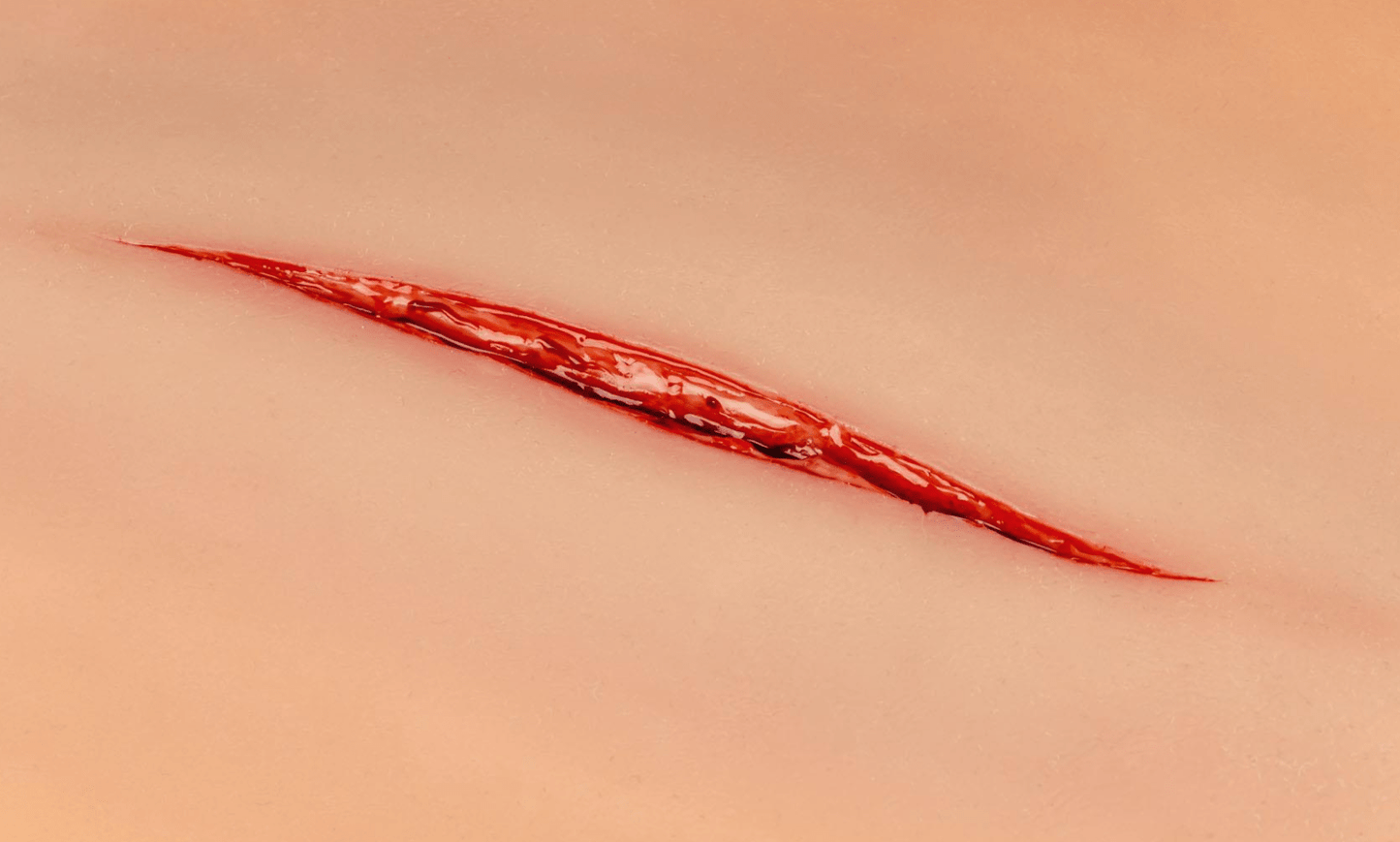 Wundmoulage Halsschnitt - Erler - Zimmer