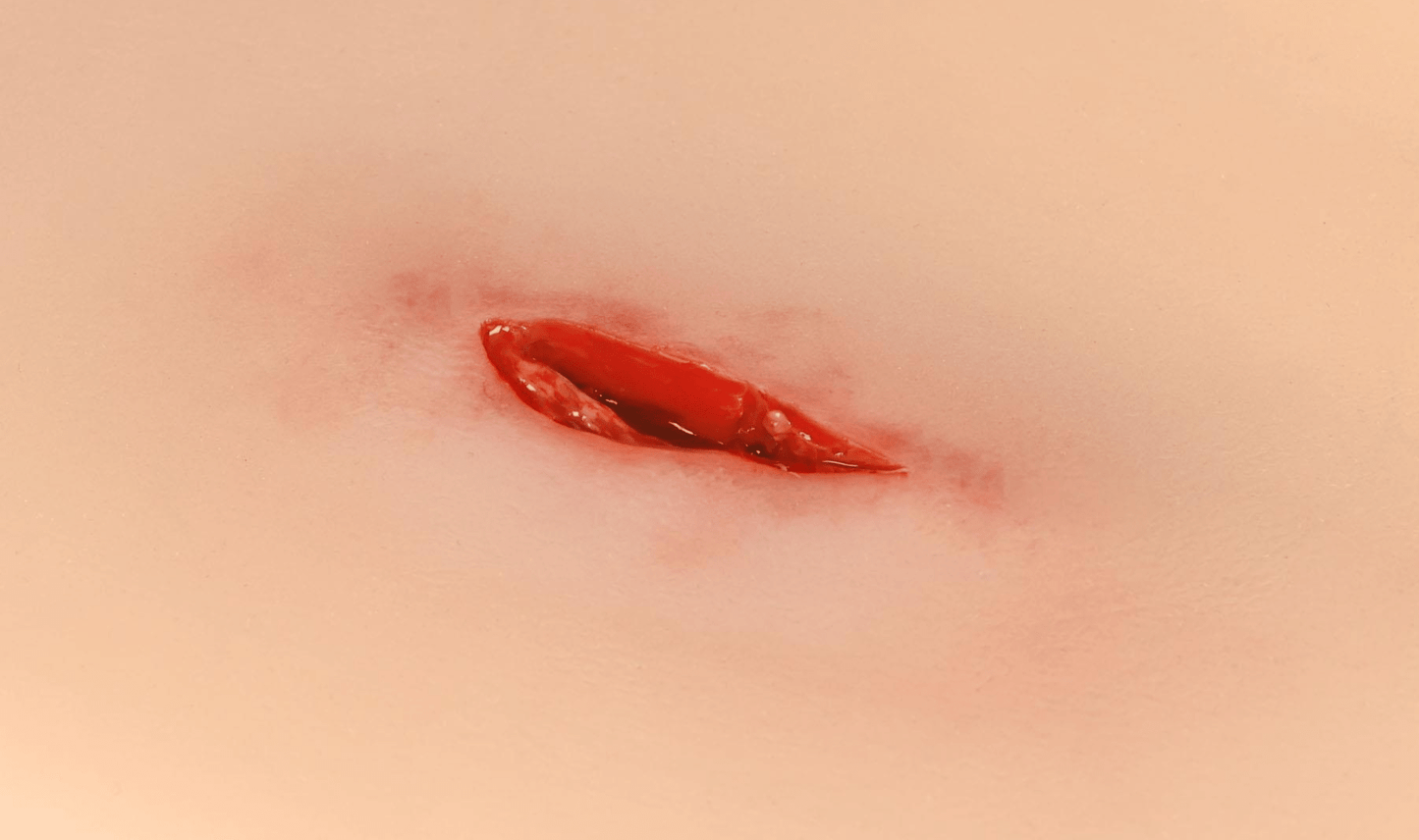 Wundmoulage Stichverletzung Hals - Erler - Zimmer