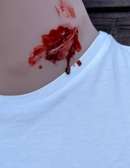 Wundmoulage Stichverletzung Hals - Erler - Zimmer