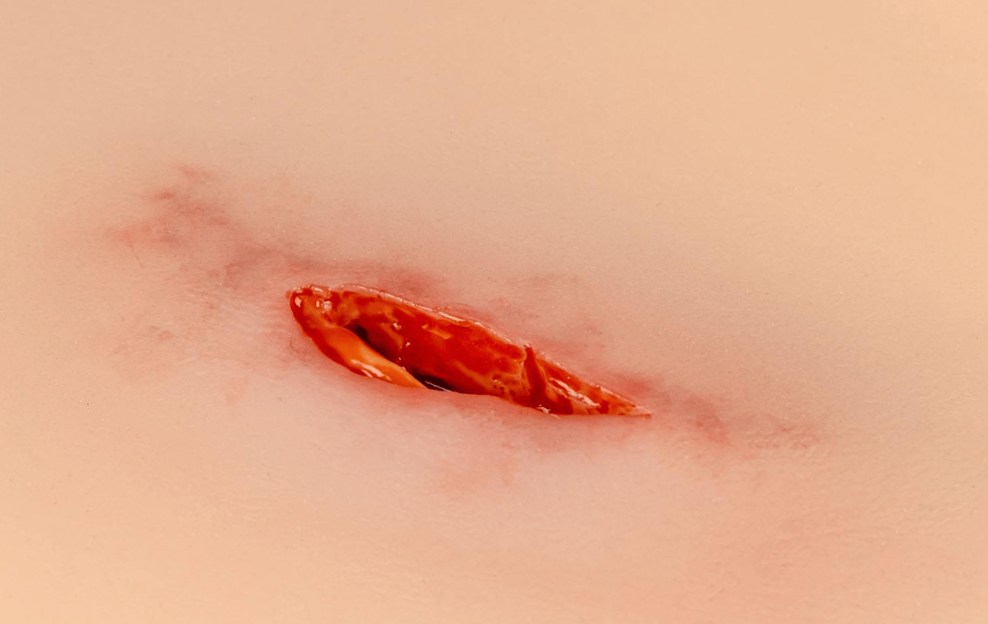 Wundmoulage Stich Oberschenkel - Erler - Zimmer