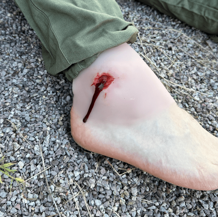 Wundmoulage Schuß Sprunggelenk - Erler - Zimmer