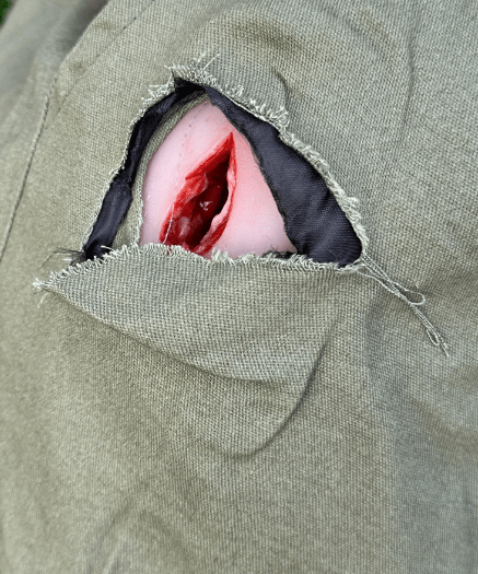 Wundmoulage Stich Leiste, Wound Packing - Erler - Zimmer