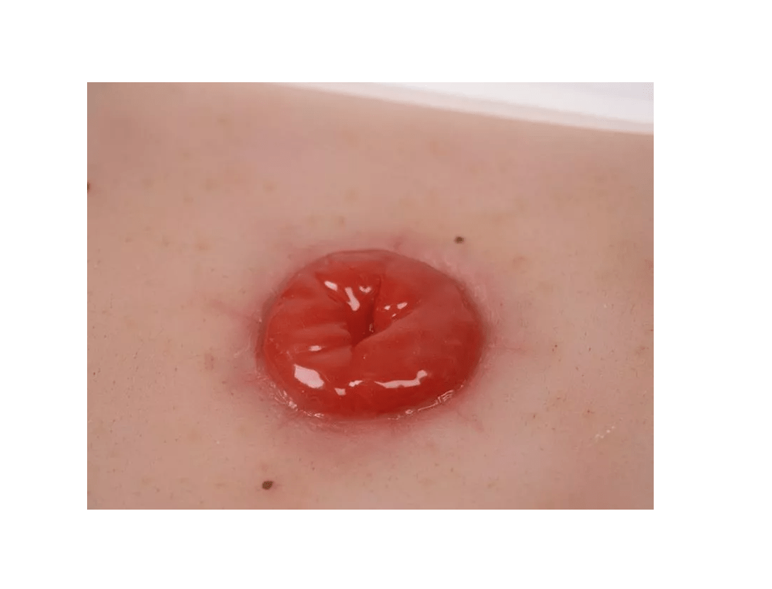 Wundmoulage Kolostoma, inkl. Stativ - Erler - Zimmer