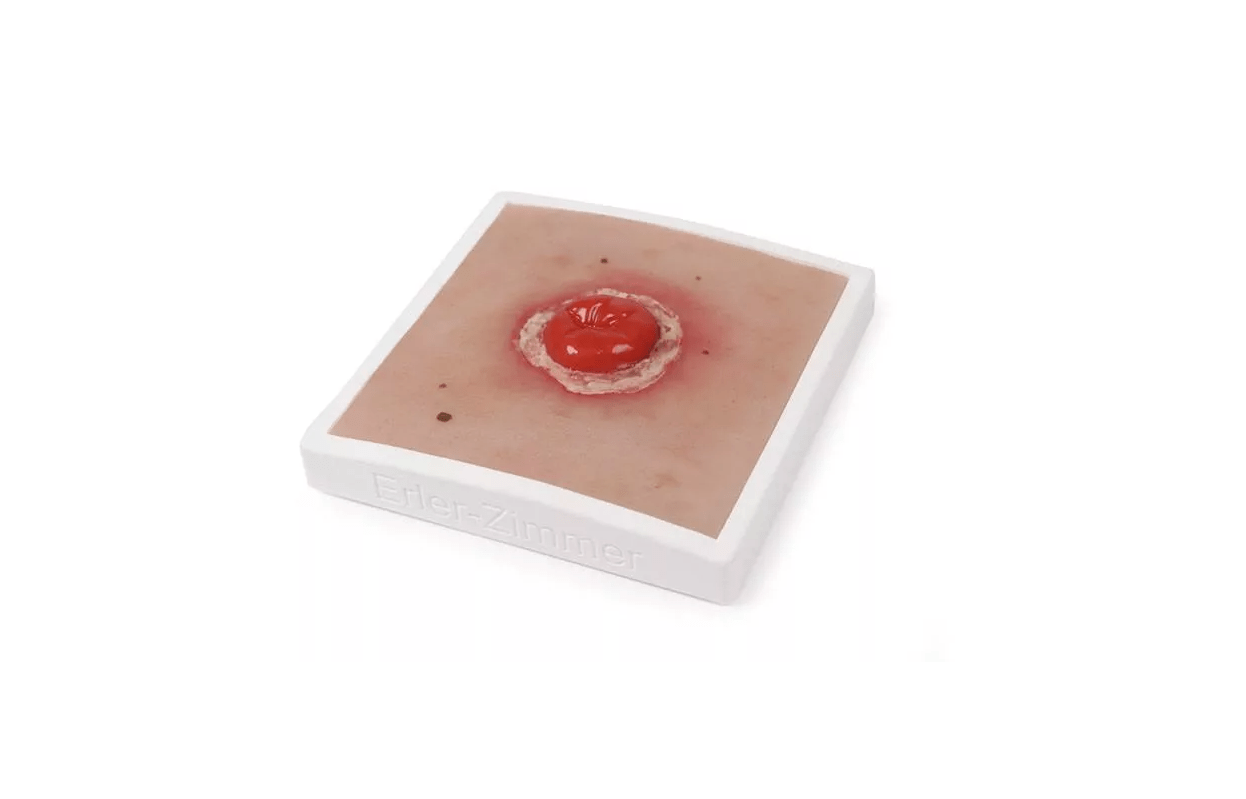 Wundmoulage Kolostoma entzündet, inkl. Stativ - Erler - Zimmer