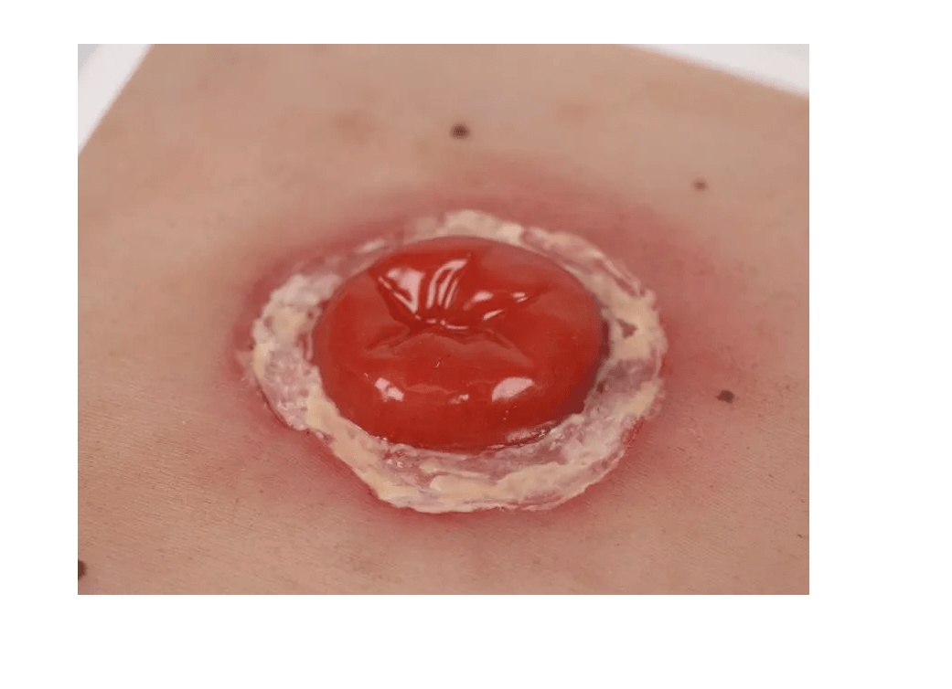 Wundmoulage Kolostoma entzündet, inkl. Stativ - Erler - Zimmer