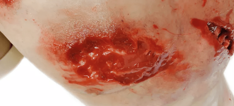 Trauma Training Torso - Erler - Zimmer