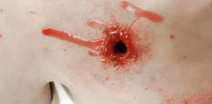 Trauma Training Torso - Erler - Zimmer
