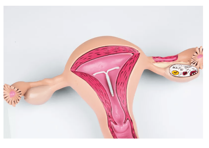 Uterusmodell - Erler - Zimmer