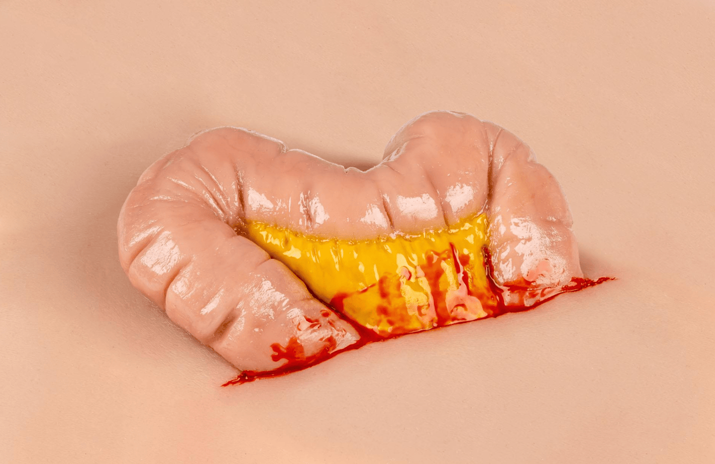 Wundmoulage Dickdarmaustritt - Erler - Zimmer