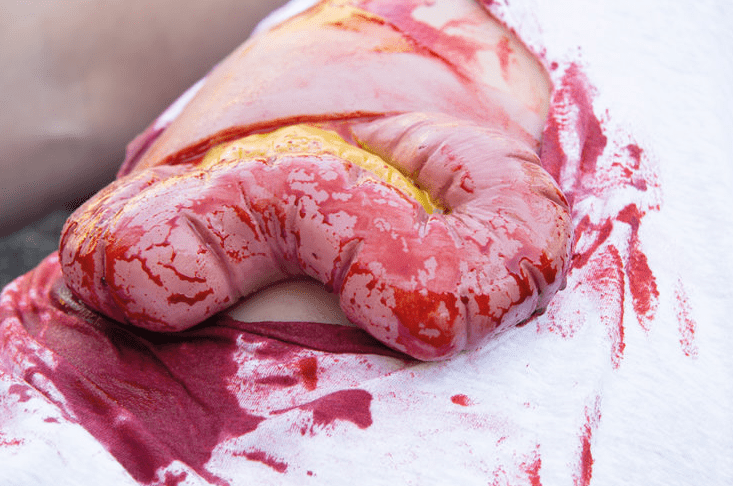 Wundmoulage Dickdarmaustritt - Erler - Zimmer