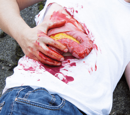 Wundmoulage Dickdarmaustritt - Erler - Zimmer