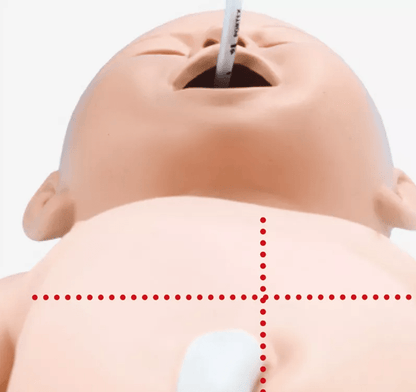 Intubations - und Wiederbelebungs - Neugeborenes - Erler - Zimmer