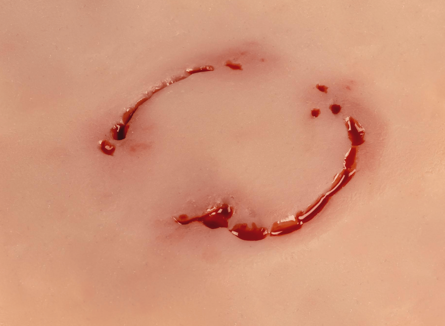 Wundmoulage Bisswunde Mensch - Erler - Zimmer