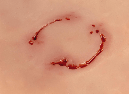 Wundmoulage Bisswunde Mensch - Erler - Zimmer