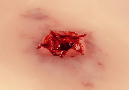 Wundmoulage Schuß Austrittswunde - Erler - Zimmer