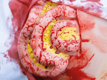 Wundmoulage Dünndarmaustritt - Erler - Zimmer