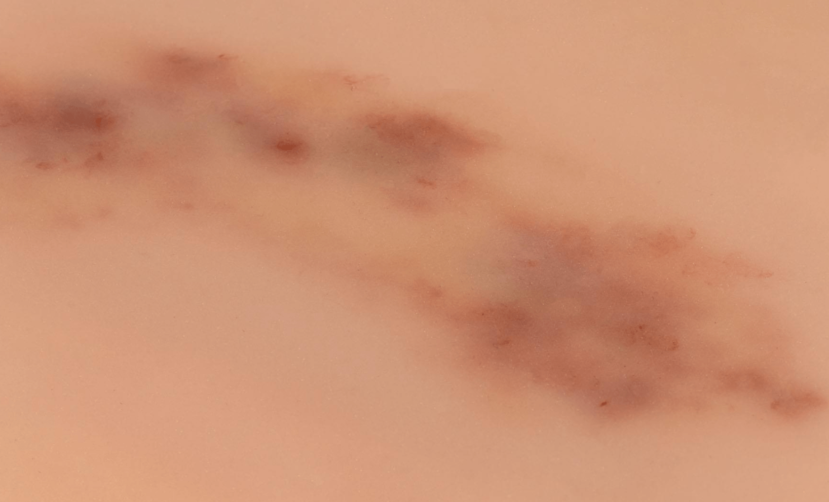 Wundmoulage Hämatom frisch - Erler - Zimmer