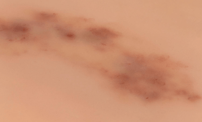 Wundmoulage Hämatom frisch - Erler - Zimmer