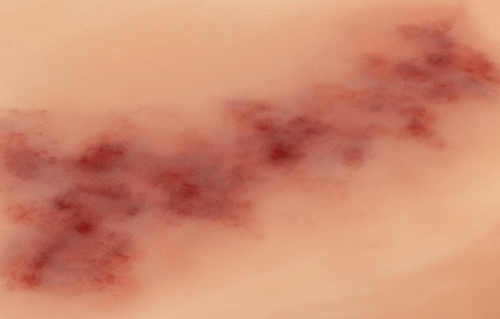 Wundmoulage Hämatom älter - Erler - Zimmer