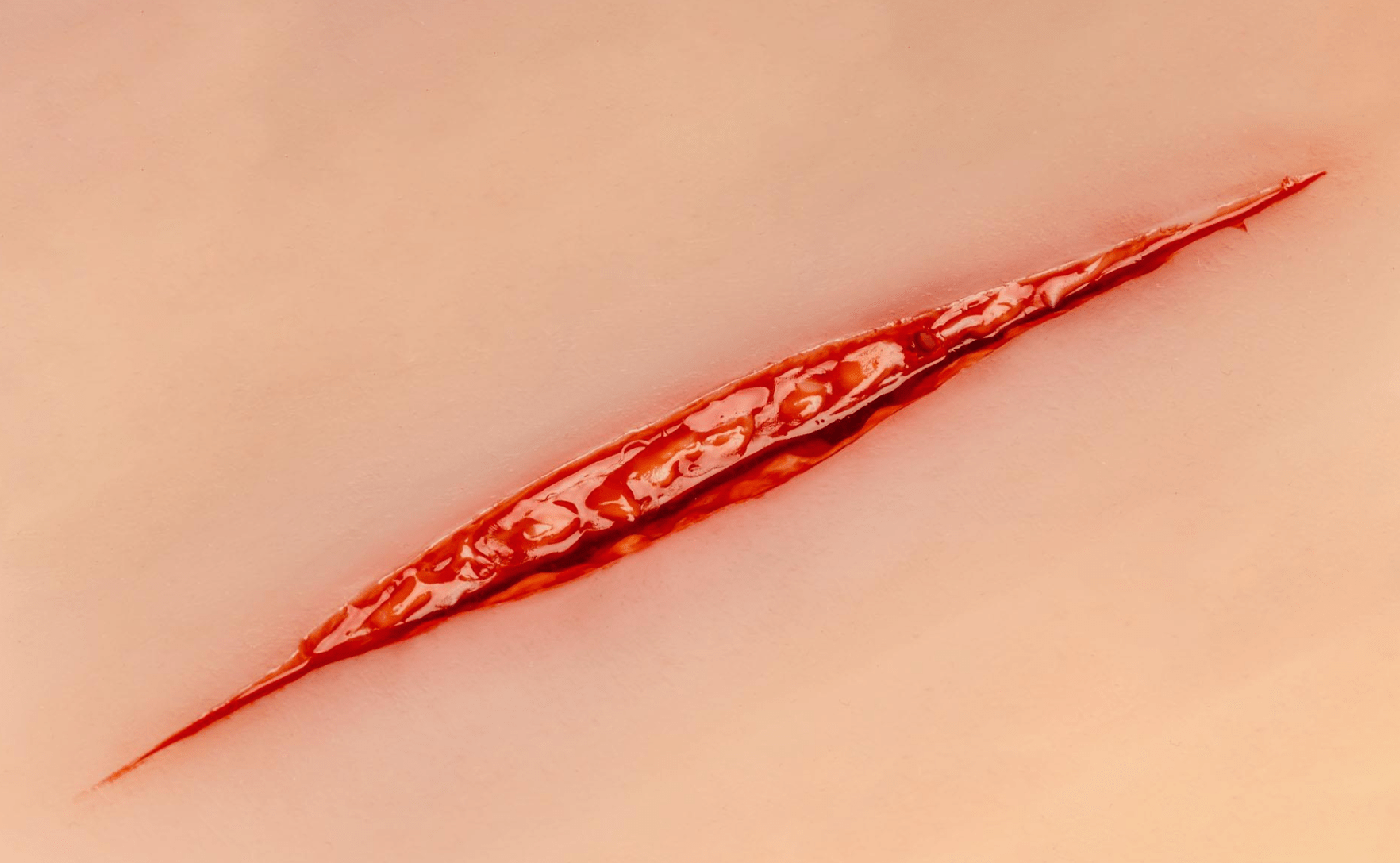 Wundmoulage Suizidversuch - Erler - Zimmer