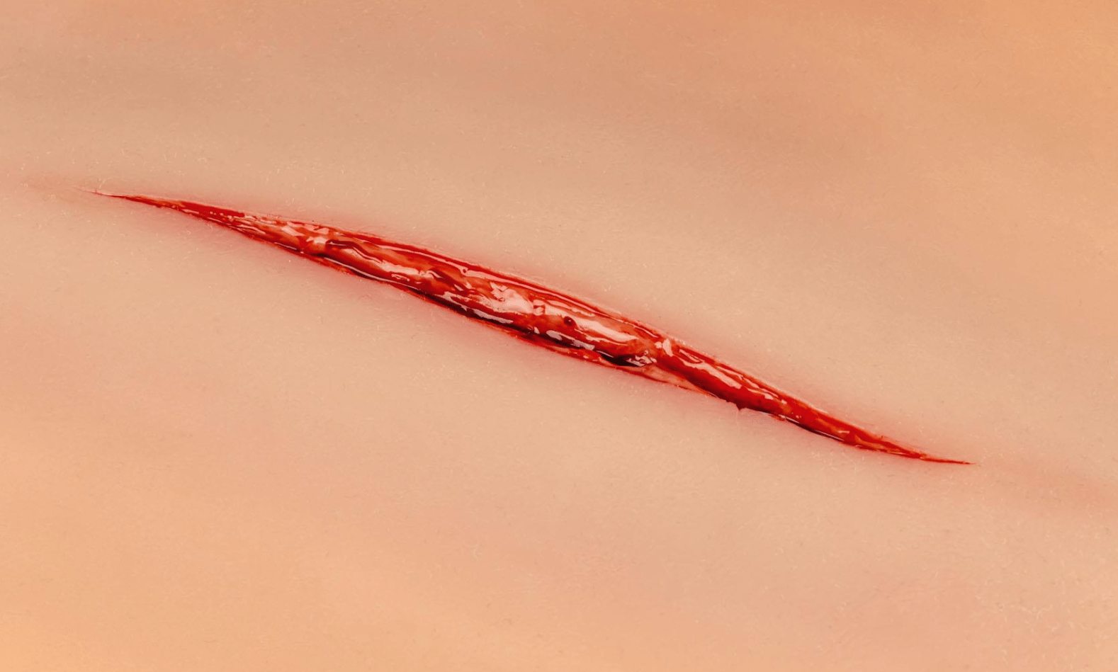 Wundmoulage Halsschnitt - Erler - Zimmer