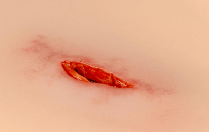 Wundmoulage Stich Oberschenkel - Erler - Zimmer