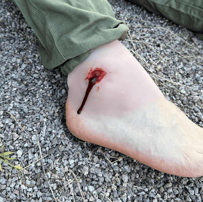 Wundmoulage Schuß Sprunggelenk - Erler - Zimmer