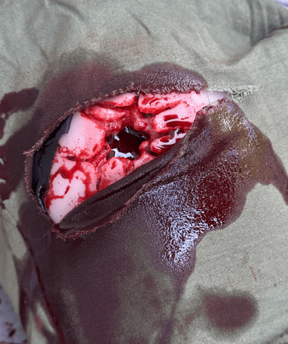 Wundmoulage Schuß Leiste, Wound Packing - Erler - Zimmer