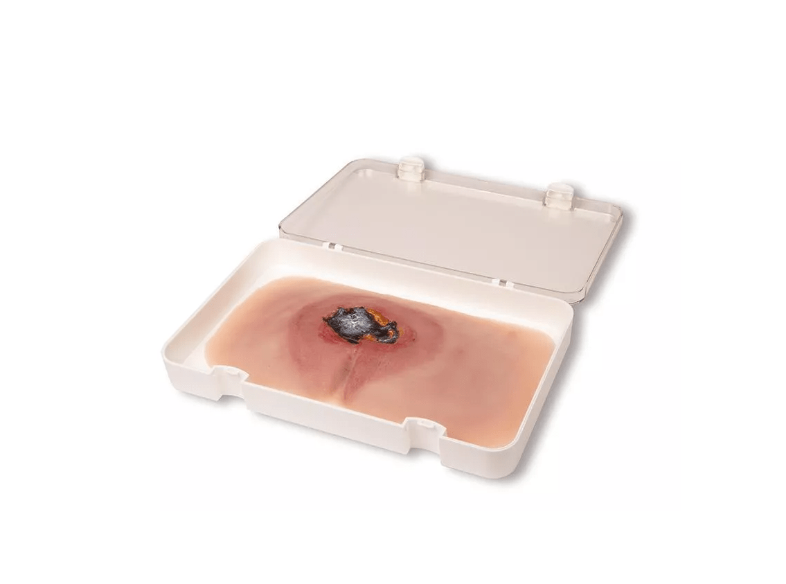Wundmoulage sakraler Dekubitus - Erler - Zimmer