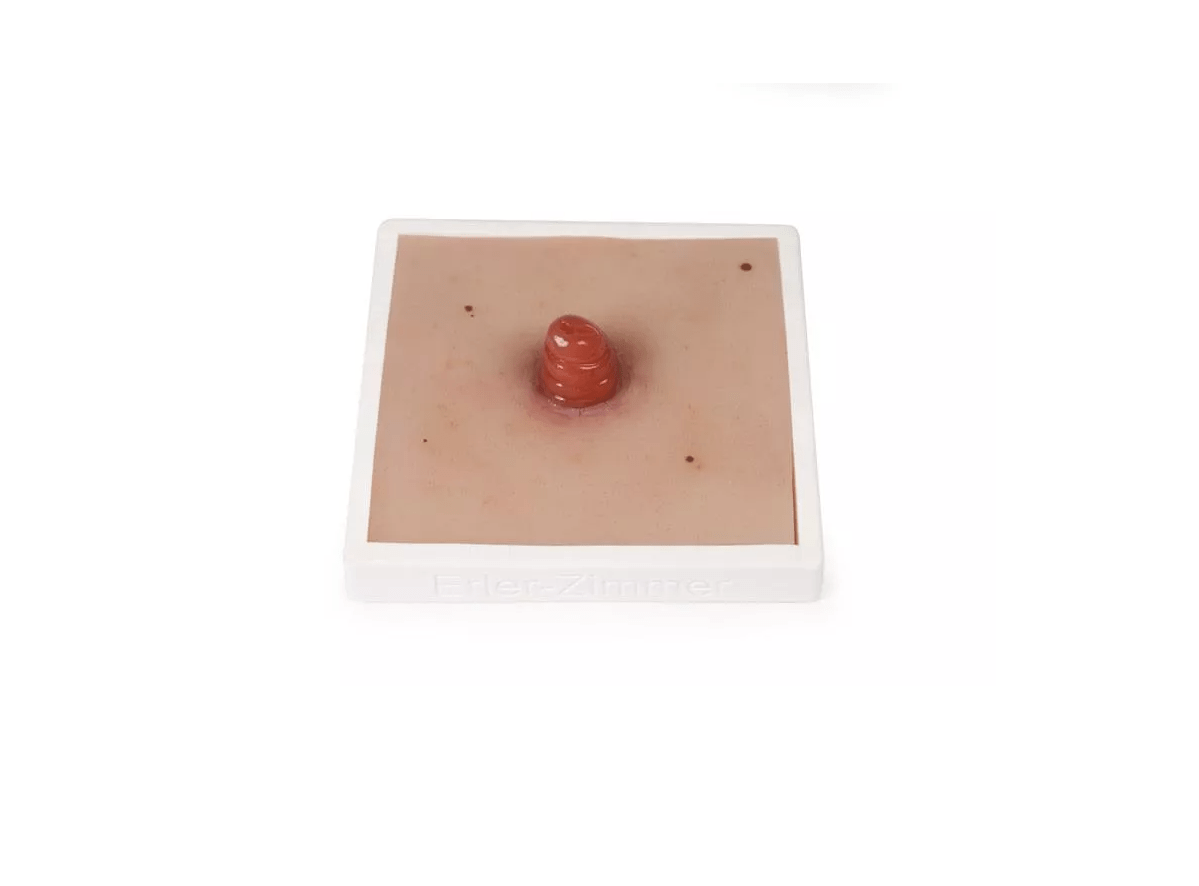 Wundmoulage Ileostoma, inkl. Stativ - Erler - Zimmer