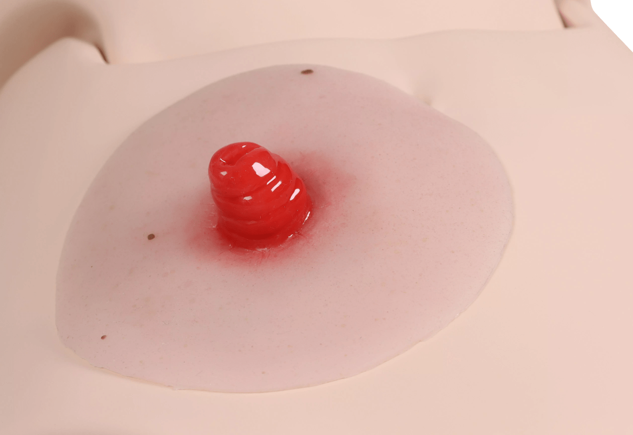 Wundmoulage Ileostoma, selbsthaftend - Erler - Zimmer