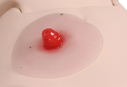 Wundmoulage Ileostoma, selbsthaftend - Erler - Zimmer