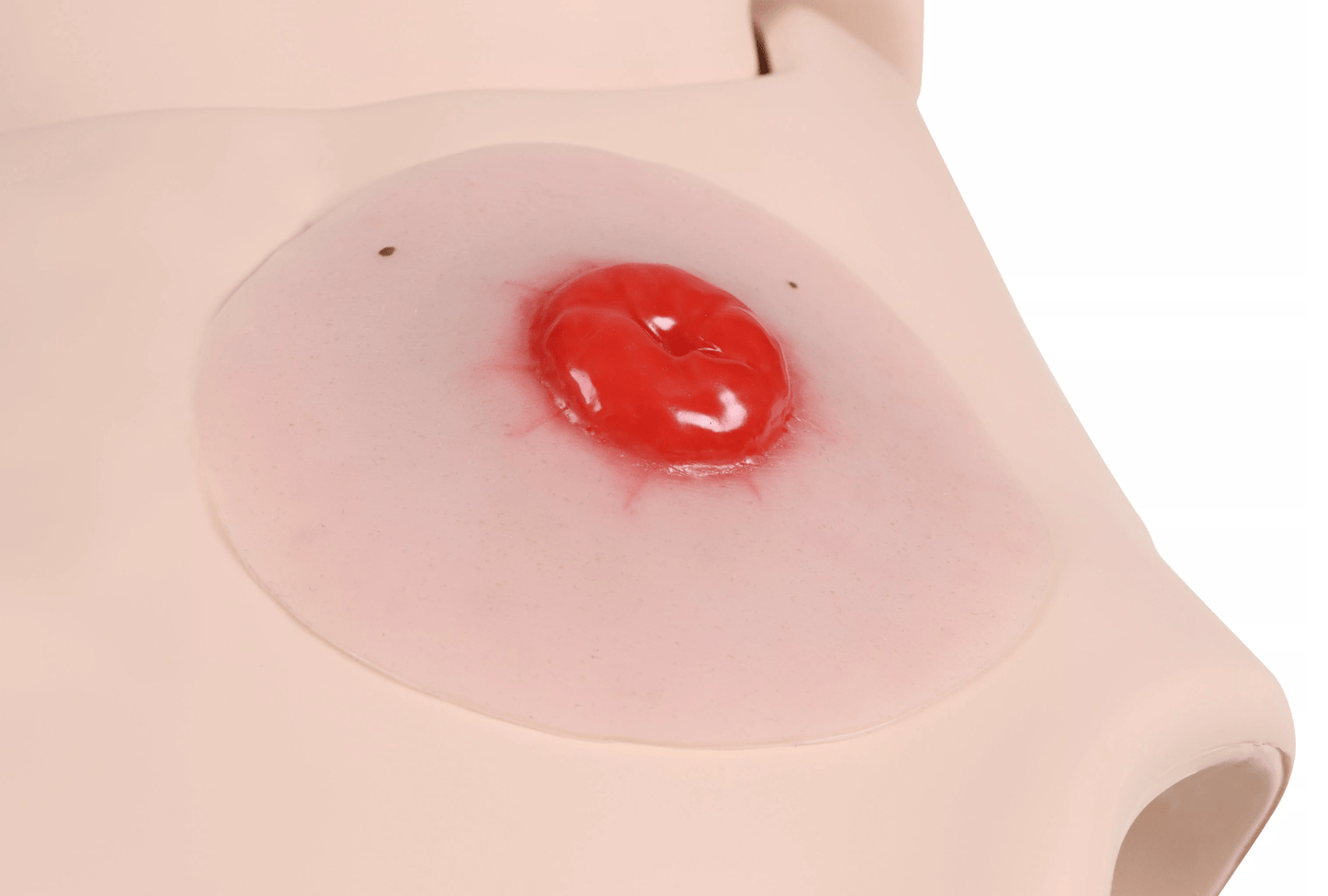 Wundmoulage Kolostoma, selbsthaftend - Erler - Zimmer