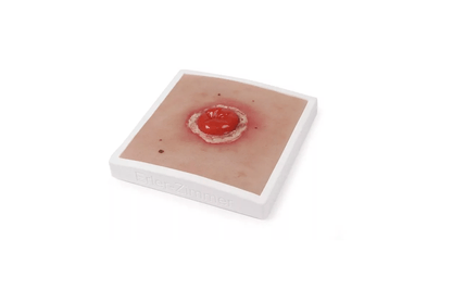 Wundmoulage Kolostoma entzündet, inkl. Stativ - Erler - Zimmer