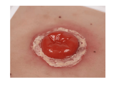 Wundmoulage Kolostoma entzündet, inkl. Stativ - Erler - Zimmer