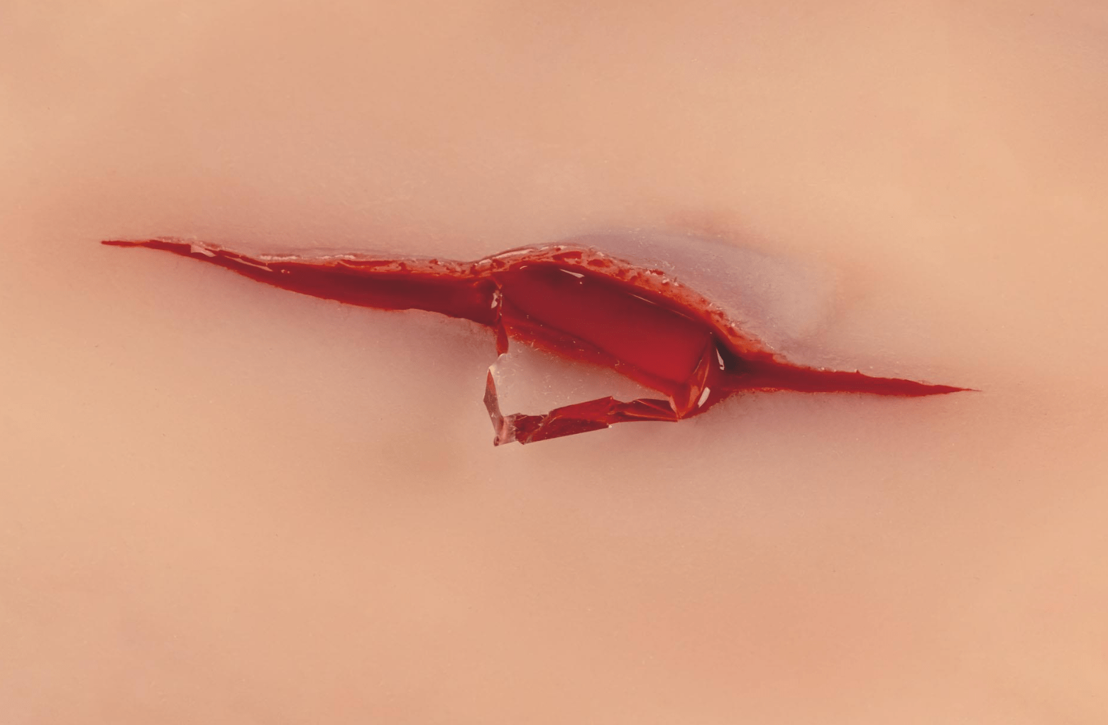 Wundmoulage Schnittwunde mit Glassplitter - Erler - Zimmer
