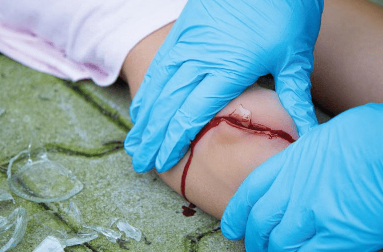 Wundmoulage Schnittwunde mit Glassplitter - Erler - Zimmer
