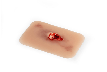 Wundmoulage offener Knochenbruch - Erler - Zimmer