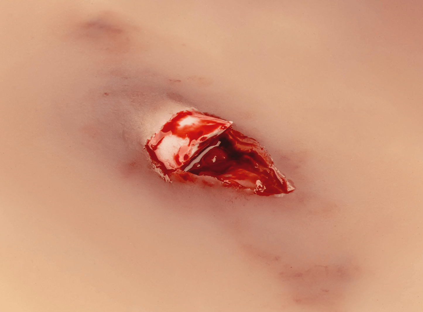 Wundmoulage offener Knochenbruch - Erler - Zimmer