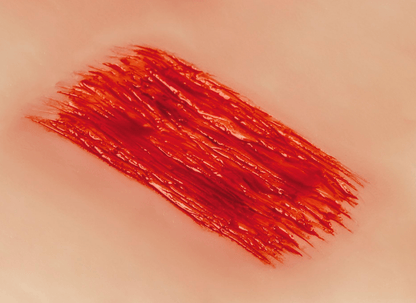 Wundmoulage Schürfwunde - Erler - Zimmer