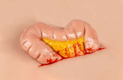Wundmoulage Dickdarmaustritt - Erler - Zimmer